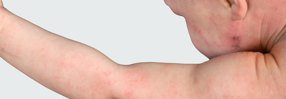 So manche Eltern von Kindern mit atopischer Dermatitis wenden die Kortison­salbe unzureichend an.