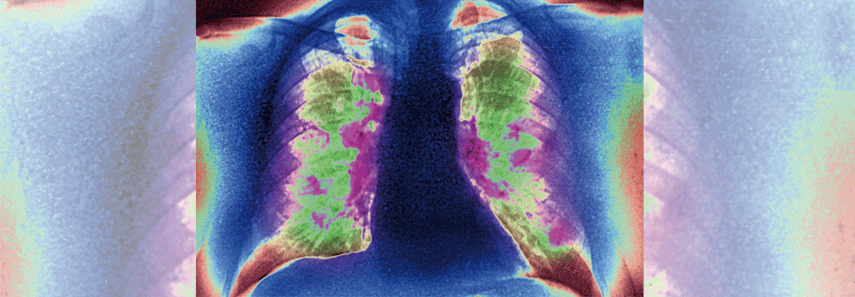 Lungenkrebs ist bei Frauen der dritt- und bei Männern der zweithäufigste maligne Tumor.