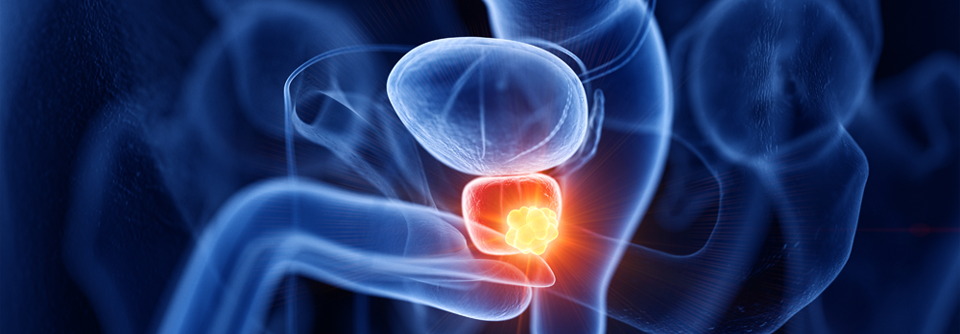 Die Basis der primären Therapie bei einem Prostatakarzinom ist der Androgenentzug.