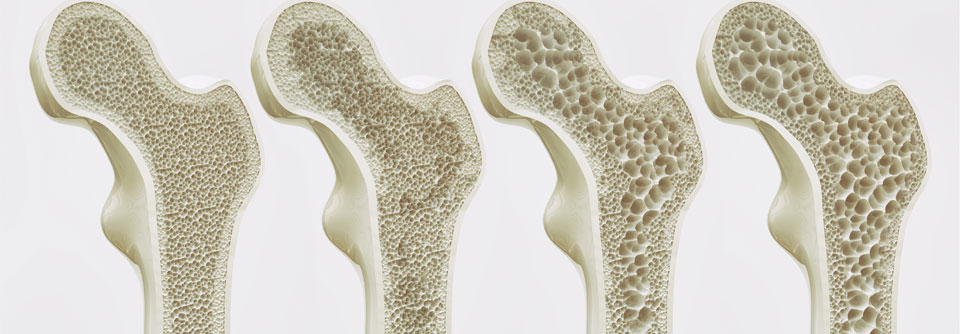 Im Oktober 2023 startet die Patientenversorgung im DMP Osteoporose.