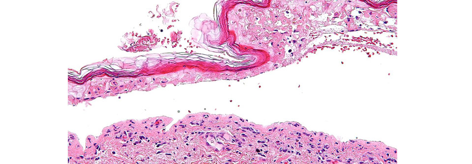 Eine Epidermale Nekrose und die Blasenbildung in tieferen Hautschichten (Trennung zwischen Epidermis und Dermis) sind typisch für SJS und TEN.