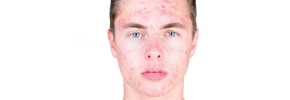 Diverse Nahrungsergänzungsmittel sollen das Hautbild von Patienten mit Akne vulgaris bessern können.