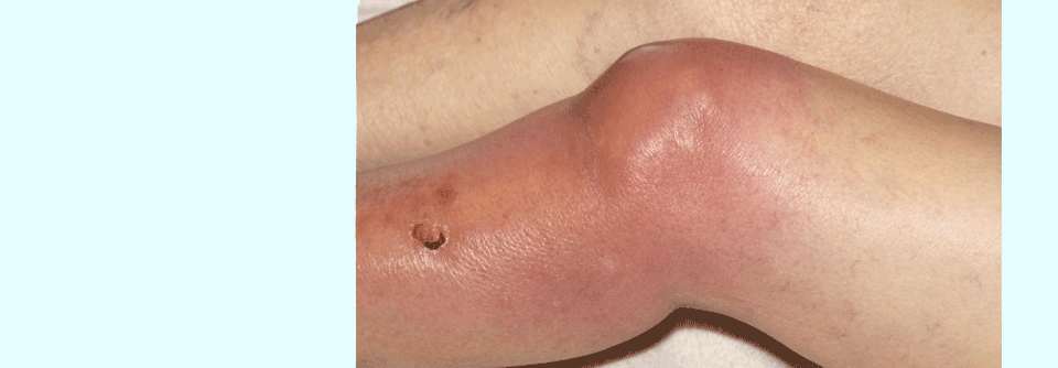 Septische Arthritis im Knie einer 88-jährigen Frau aufgrund einer Infektion mit MRSA.