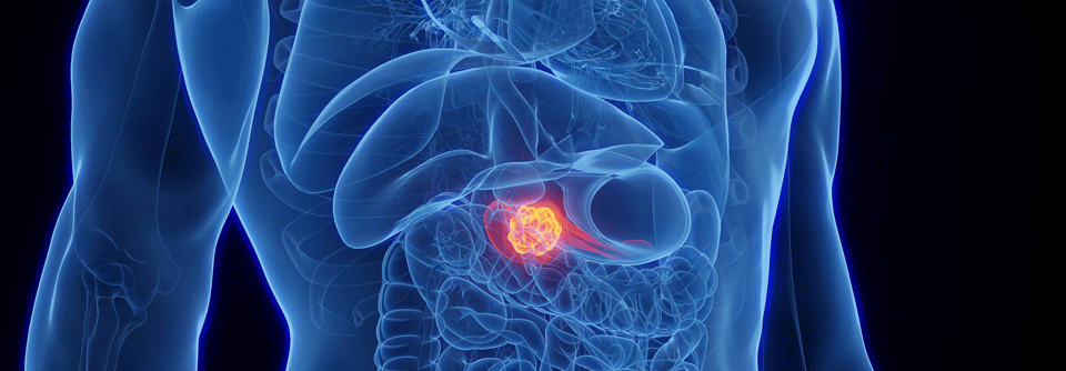 Eine dosisreduzierte Chemotherapie könnte Pankreaskrebs Patient:innen helfen.