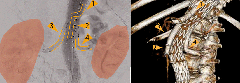 Dieses thorakoabdominelle Aortenaneurysmas wurde mit einem Stent ausgeschaltet, links erkennt man das Nierenparenchym  (orange) und rechts den Stent mit vier Seitenarmen – zum Anschluss an Truncus coeliacus (1), Arteria mesenterica superior (2) und beide Nierenarterien (3,4).