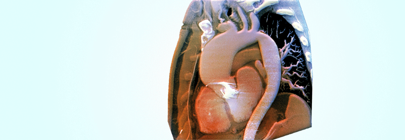 Ein thorakales Aneurysma betrifft meist Aortenwurzel und Aorta ascendens. Die Aorta descendes ist seltener betroffen.
