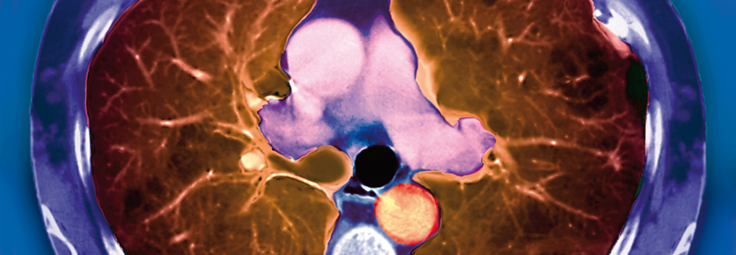 Werden im CT Emphyseme sichtbar, steigt die Wahrscheinlichkeit, dass eine COPD vorliegt.