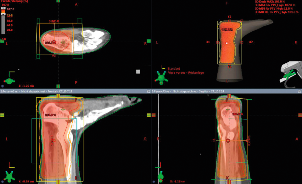 Mittels CT wird die Bestrahlung eines Patienten mit Achillodynie und Fersensporn geplant.
