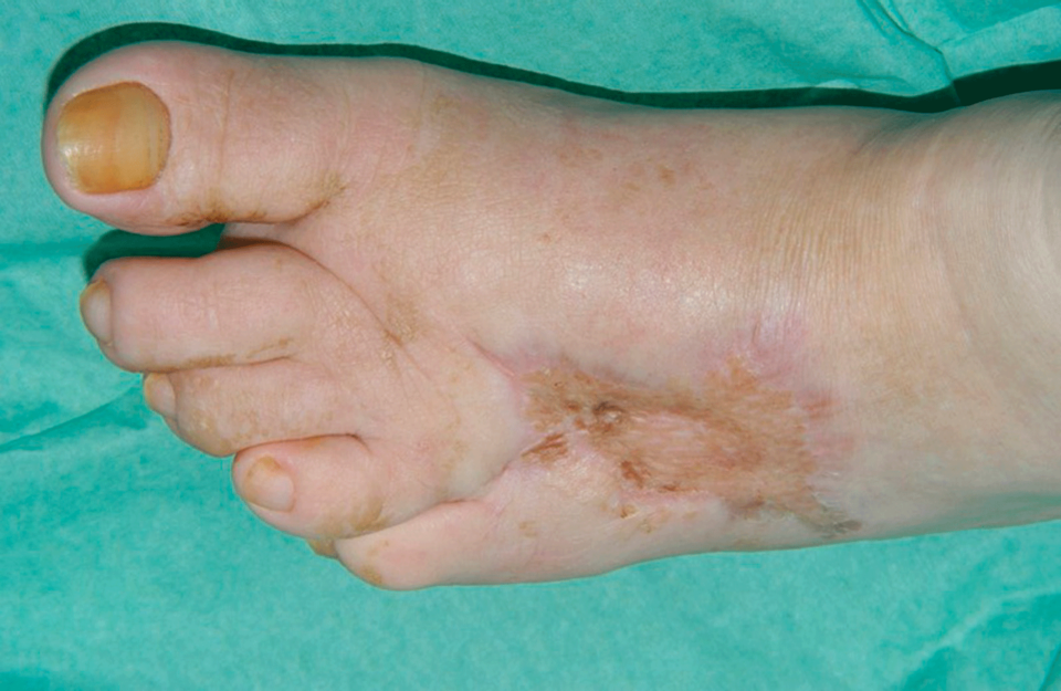 Eine klassische Phlegmone beim diabetischen Fußsyndrom sechs Wochen nach Therapie.
