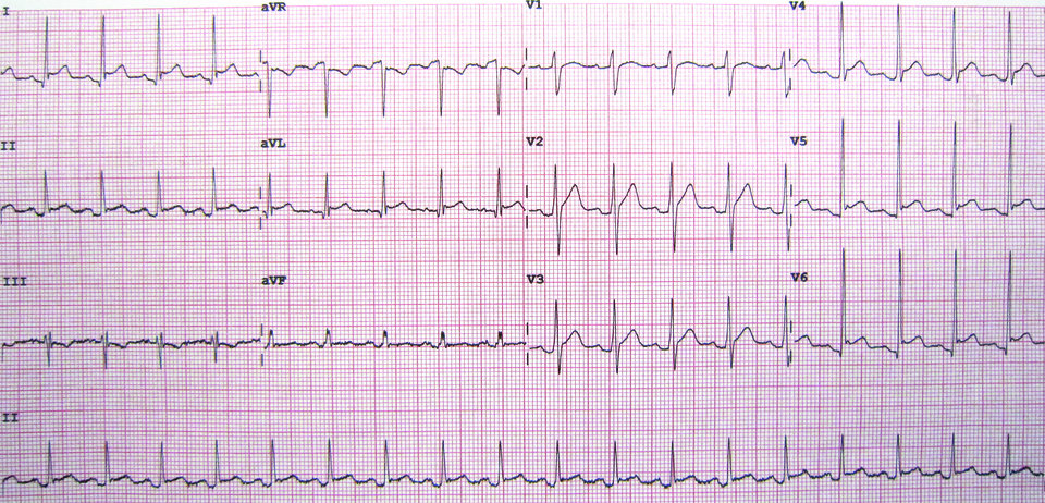 In diesem Perikarditis-EKG sieht man ST-Hebungen über der Vorderwand. 
© wikimedia/James Heilmann.