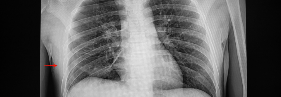 Das Risiko eines Pneumothorax nach transbronchialer Lungenbiopsie liegt unter 1 %. 