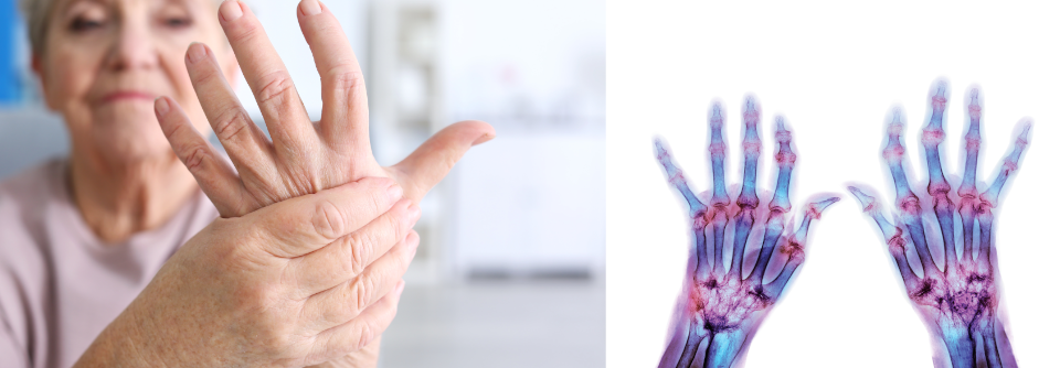 Die rheumatoide Arthritis ist in Deutschland die häufigste entzündlich-rheumatische Erkrankung. 