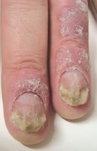 Dass von gribka des Nagels gut hilft
