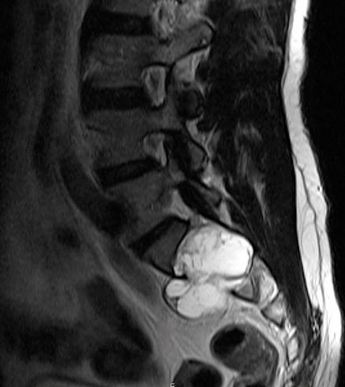 Untypische Manifestationen von spinalen Schwannomen – vier Fallbeispiele 