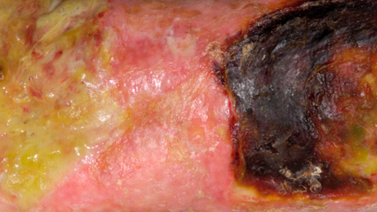 Pyoderma gangraenosum ist gefährlich, aber behandelbar