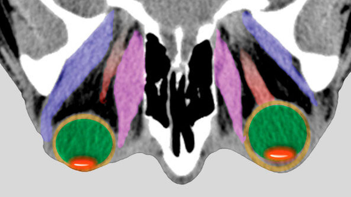 Morbus Basedow: Diagnostik und Therapie