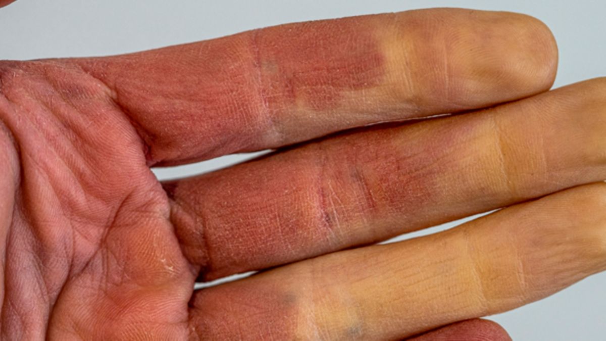 Raynaud-Syndrom: Sekundäre Ursachen stets ausschließen
