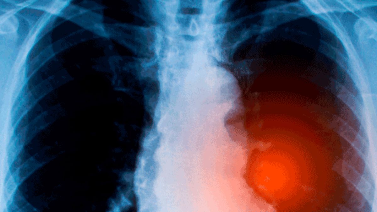 NSCLC: TKI-Resistenzen umgehen