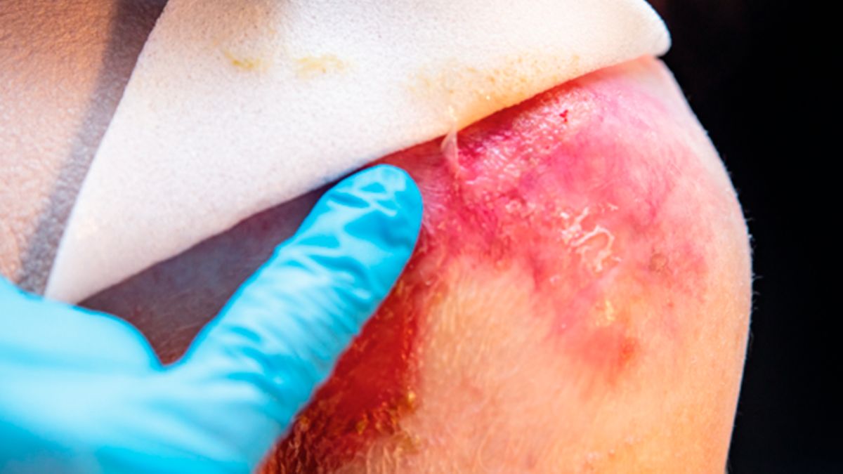 Dystrophe Epidermolysis bullosa mit Topika heilen?
