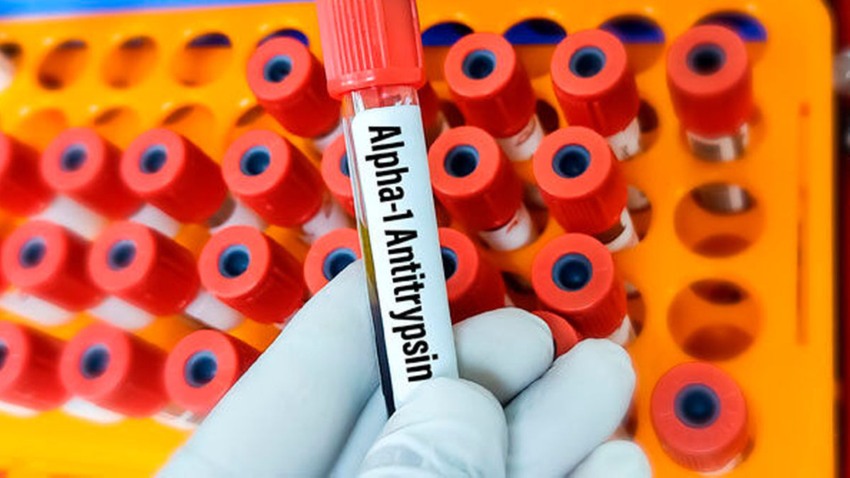Intravenöse Enzymgabe: Mehr Therapiesicherheit bei Alpha-1-Antitrypsin ...