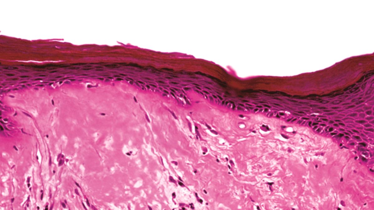 Lichen sclerosus: S3-Leitlinie mit neuen Empfehlungen