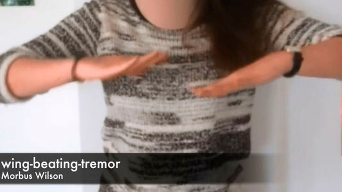 Typisch für Morbus Wilson: Der Wing-beating-Tremor