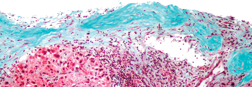 Typisch nach langer Hepatitis B: Fibrose (blau) und Krebs.