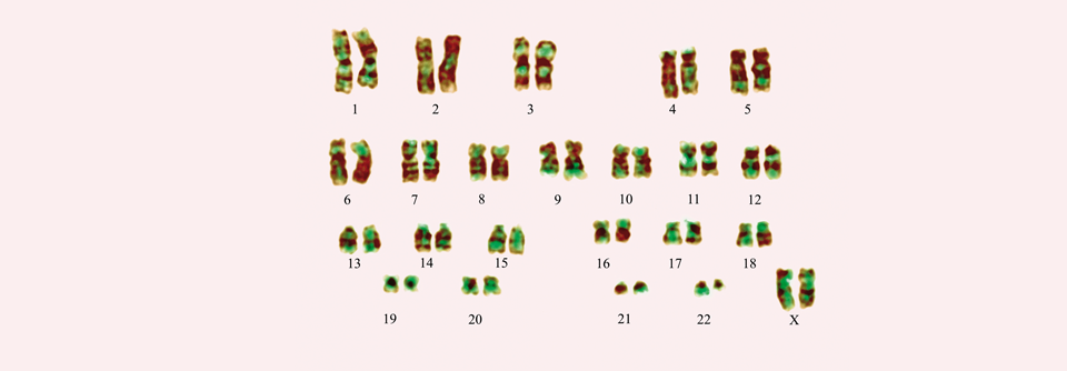 Eine Translokation zwischen den Chromosomen 9 und 22 (hier: jeweils das 
rechte) kann eine CML auslösen.