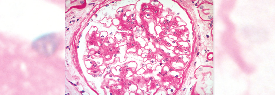 Ein dauerhaft erhöhter BZ führt zu Schäden an den Glomeruli der Niere.