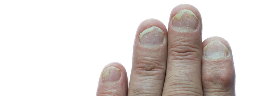 Durch den Nagelbefall ist die Systemtherapie auch bei leichter Hautbeteiligung indiziert.
