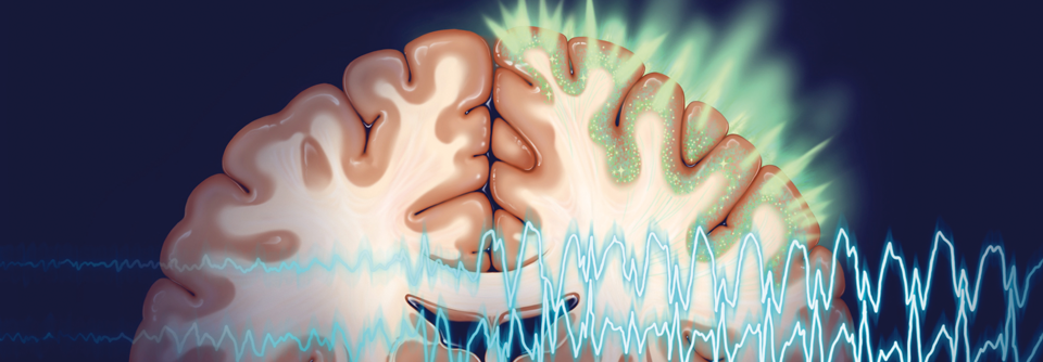 Jeder zehnte epileptische Anfall hat seine Ursache in einer zerebralen Ischämie oder eine Hirnblutung, wobei das Krampfrisiko bei hämorrhagischen Insulten größer ist als bei ischämischen.