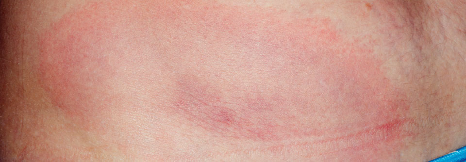 Die Lyme-Borreliose macht sich auch auf der Haut bemerkbar.