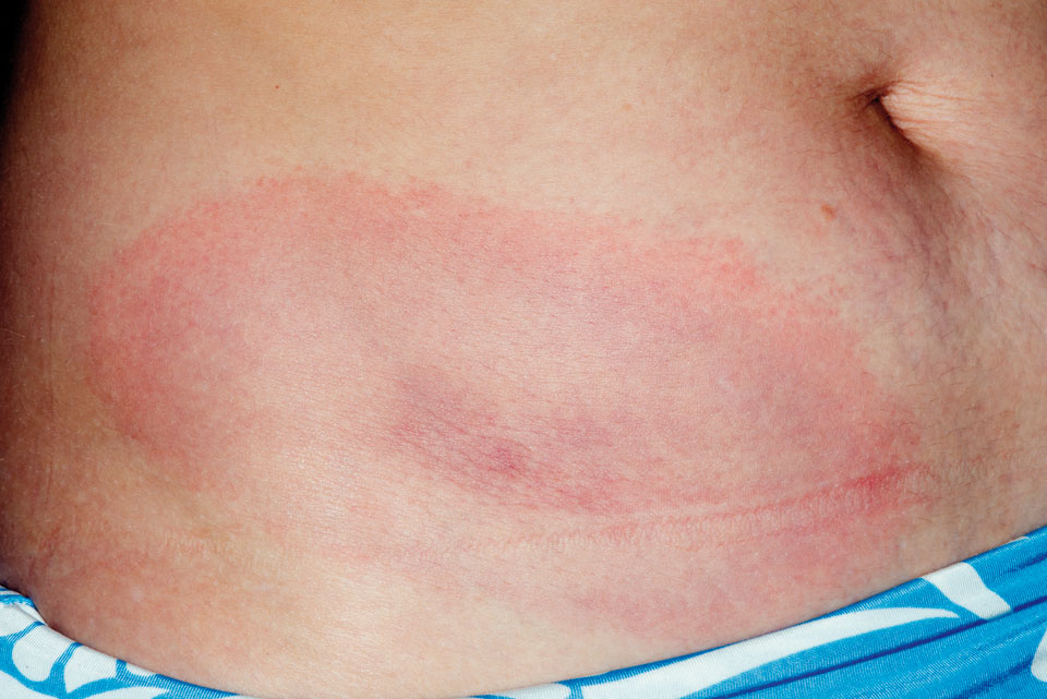 Erythema migrans am Bauch mit typisch betontem Randsaum.