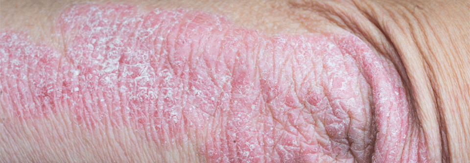 Ein schuppendes Ekzem an den Streckseiten von Unterschenkel und Ellbogen ist typisch für eine Psoriasis.
