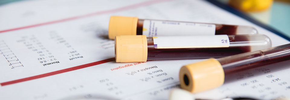 PARP-Inhibitoren fördern offenbar myeloische Erkrankungen
