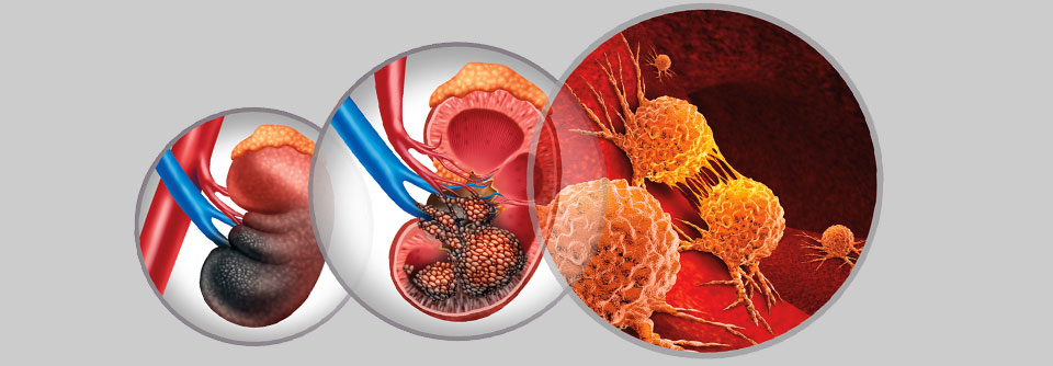 Der Tumorgrad des Nierenzell­­karzinoms wird auf Basis des WHO-ISUP-Gradings ermittelt.