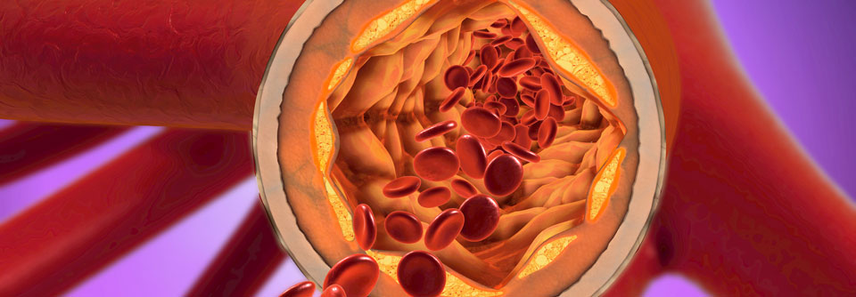 Bypass zur Arteria axillaris leitet Blut am Carotis-Verschluss vorbei