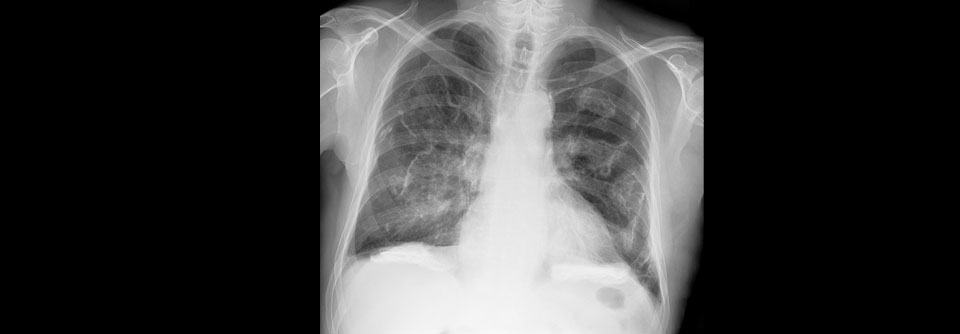 Bei einem 64-Jährigen zeigen sich im Röntgenthorax pleurale Verdickungen nach früherer Asbestexposition.
