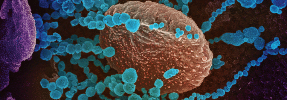 Eine Infektion mit SARS-CoV-2 (blau) kann auch Jüngere hart treffen.