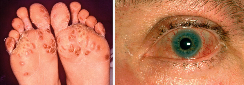 Reaktive Arthritis: Symptome und Differenzialdiagnosen Das Reiter-Syndrom geht bisweilen auch mit einer Keratoderma blennorrhagicum oder Konjunktivitis einher. Häufiger Auslöser einer reaktiven Arthritis ist Chlamydia trachomatis.