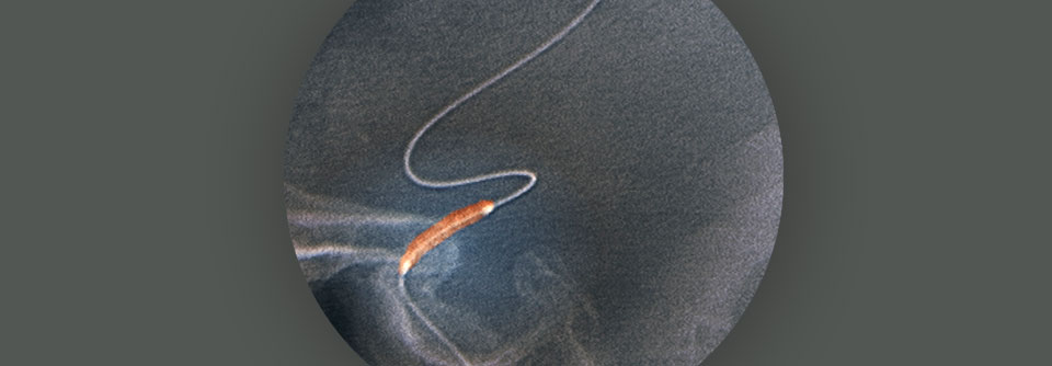 Stent kann bei extrakranieller Dissektion der Halsschlagader die Prognose bessern Wie bei einer Stenose hilft der Stent auch beim Riss.