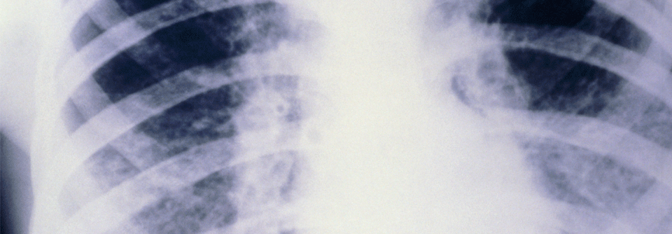 Die meisten Patienten mit zystischer Fibrose sterben durch eine respiratorische Insuffizienz, zu der auch die chronische Infektion mit P. aeruginosa beiträgt.