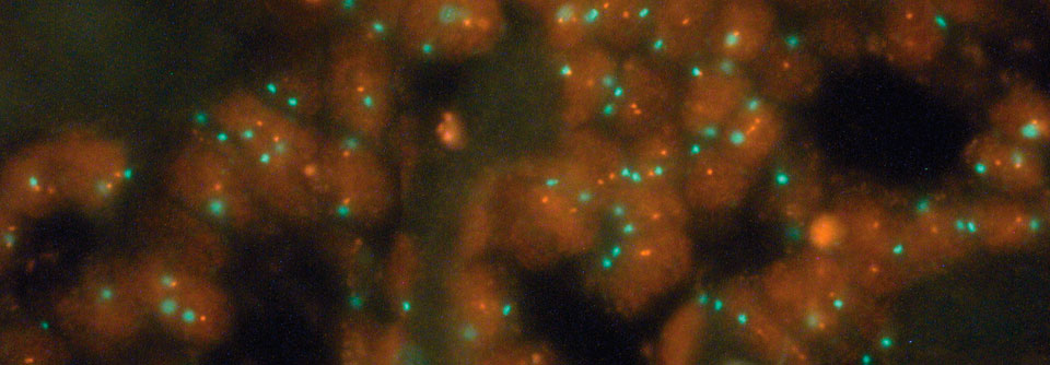 In der Fluoreszenz-in-situ-Hybridisierung (FISH) sieht man die HER2-Amplifikation dieser Brustkrebszellen deutlich.