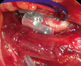 Intraoperativ wird die Cuff-Elektrode um den Hauptstamm des Nervus hypoglossus geschlungen.