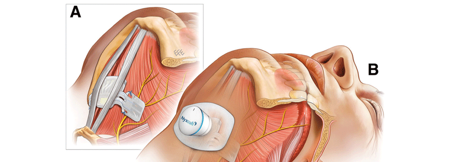Bei der beidseitigen Hypoglossus-Stimulation wird nur eine zweiflügelige Elektrode implantiert.