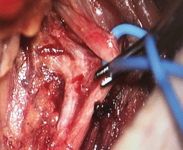 Für die atemsynchrone Hypoglossus-Stimulation müssen einzelne Äste des Nerven präpariert werden.