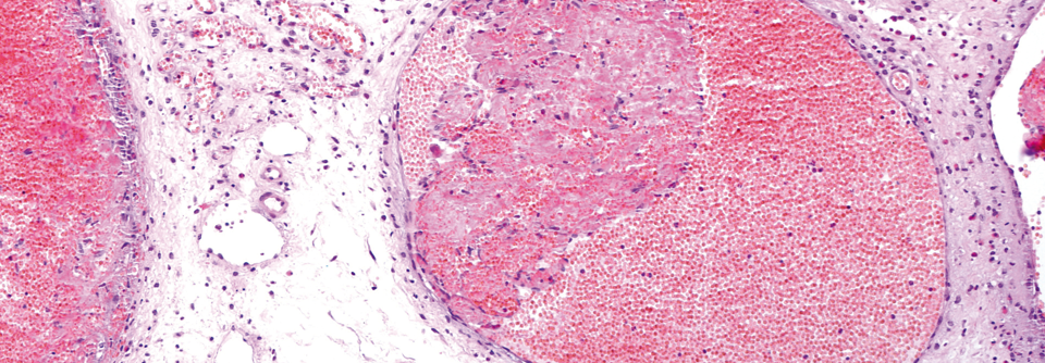 Infantile Hämangiome entstehen durch Proliferation von Endothelzellen.