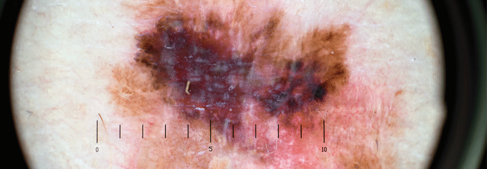 Intermittierende BRAF/MEK-Inhibition beim Melanom ohne Vorteil