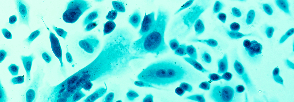 Chemoimmuntherapie beim metastasierten Prostatakarzinom wirksam