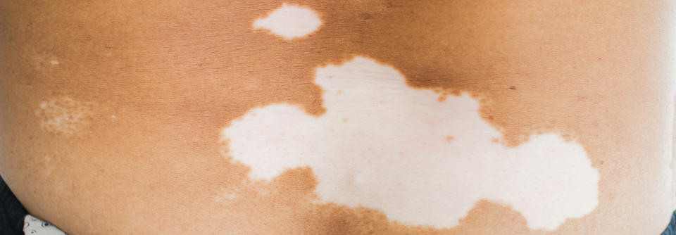 Vitiligo: Welche Zelltransplantationsmethode kommt infrage?
